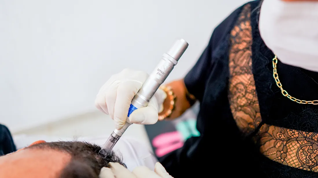 Aplicação de bioestimulador de colágeno
